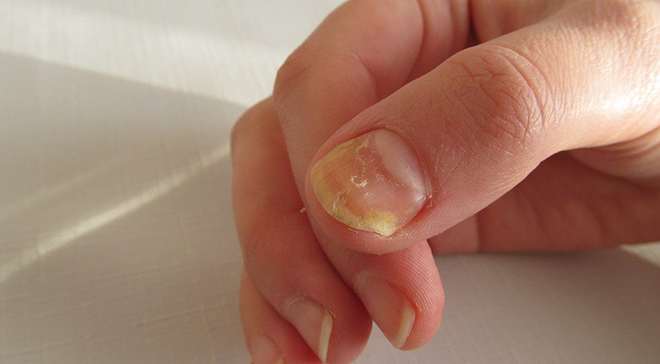 How to Pick the Right Remedy for Nail Fungus Without Wasting Time