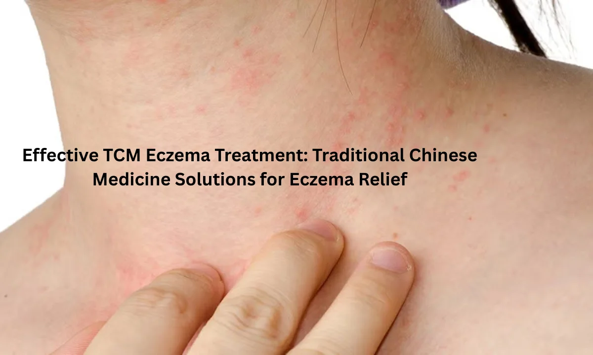 Effective TCM Eczema Treatment Traditional Chinese