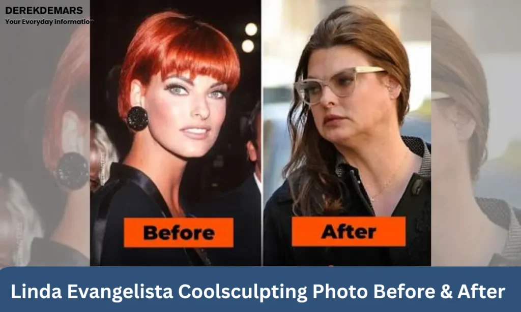 Linda Evangelista Coolsculpting Photos - Before & After