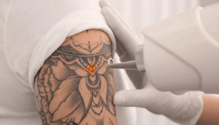 Your First Tattoo Removal Session
